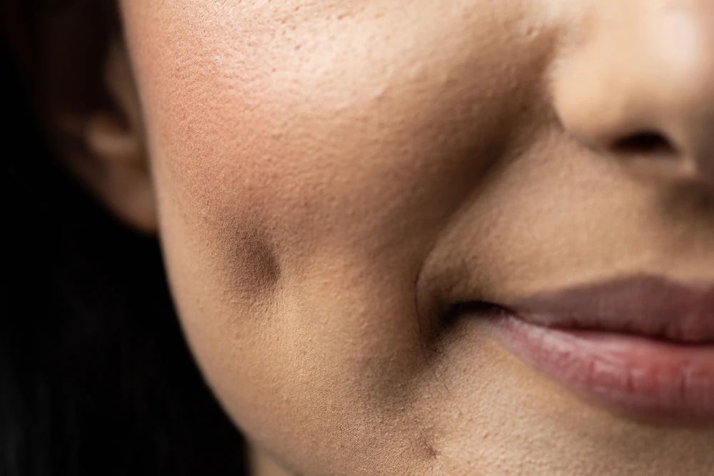 Dimpleplasty, una tendencia que tienes que pensar dos veces | Qué Onda |