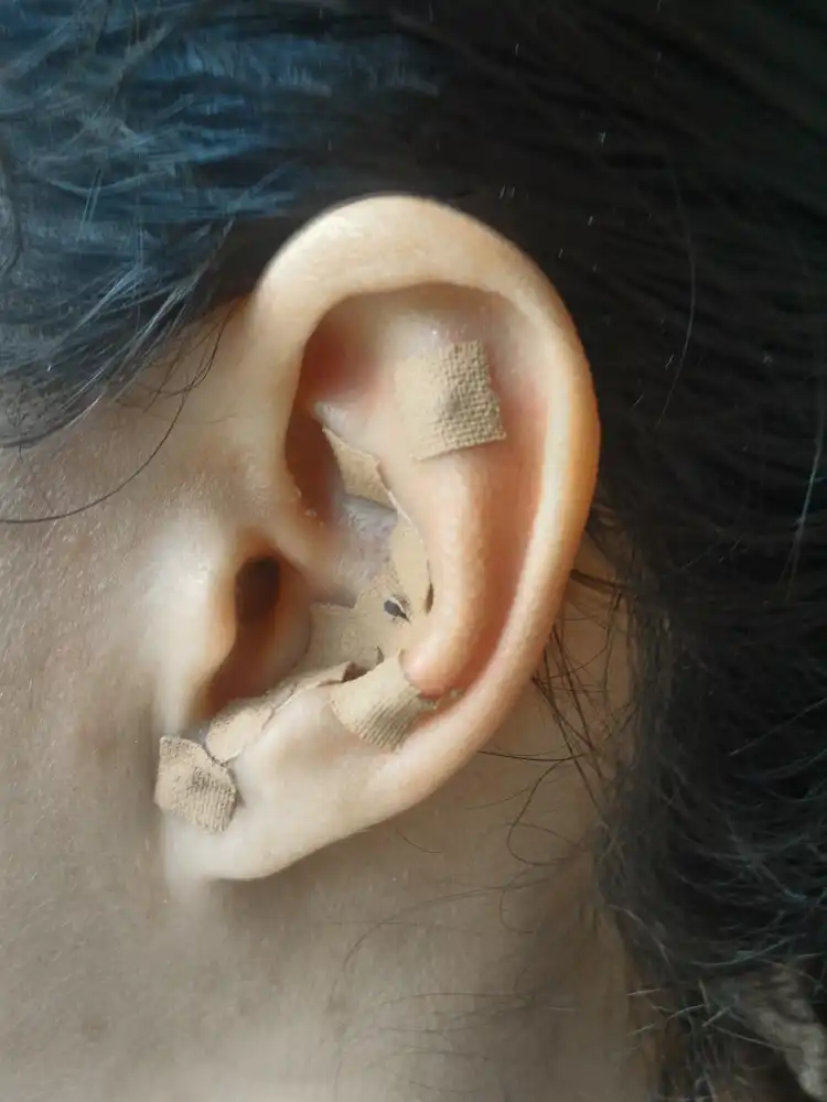 La auriculoterapia es útil para fisioterapeutas | Qué Onda |